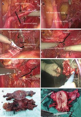 Can laparoscopic nerve-sparing ultra-radical hysterectomy play a role in locally advanced cervical cancer? A single-center retrospective study